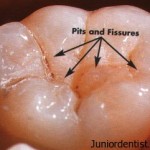 Pit and Fissure Sealents History