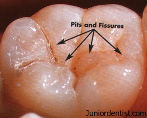 Pit and Fissure Sealents History