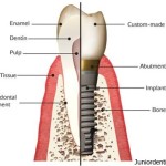define dental implants