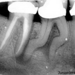 Running or Dancing Root Canals