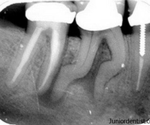 Running or Dancing Root Canals
