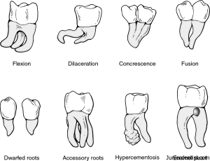Anamolies of Tooth in the form of Variations in Root Form