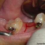 types of Dental incision and instruments used