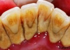 Crystal forms in sub gingival and supra gingival calculus