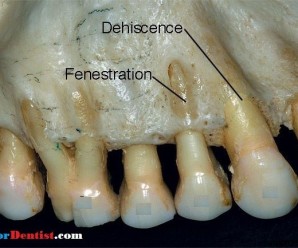 Dehiscence and Fenestration