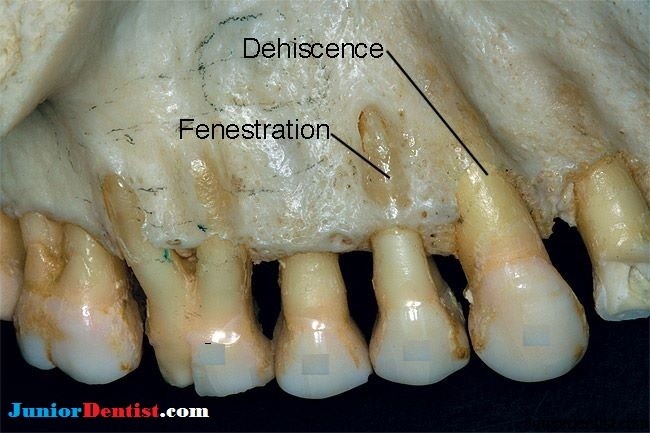 Dehiscence and Fenestration
