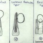 Differences between periapical lateral radicular and residual cyst