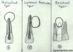 Differences between periapical lateral radicular and residual cyst
