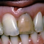 Discoloration of tooth due to Trauma