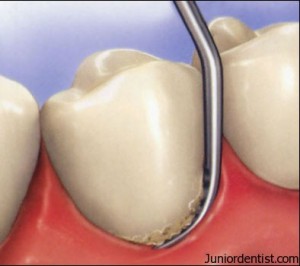 Scaling in restorative dentistry