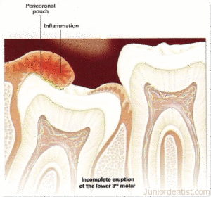 pericoronitis - pericoronal pouch or operculum