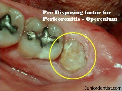 Predisposing factor for pericoronitis
