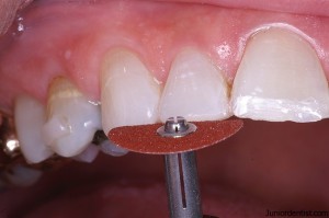 reshaping teeth - cosmetic dentistry