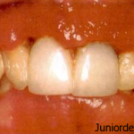 ANUG - Punched out lesions of the interdental papilla