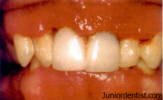 ANUG - Punched out lesions of the interdental papilla