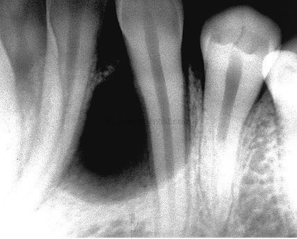 AOT - Radiographic feature