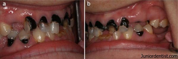 Caries Susceptibility in primary and permenant teeth