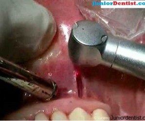 Effects of Laser of Oral Tissue