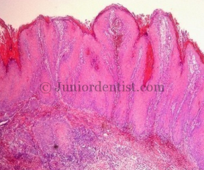 Important histological features of Oral Carcinomas