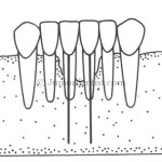Endodontic implants uses