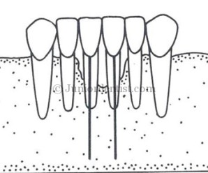Endodontic implants uses