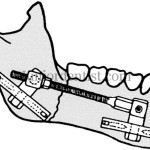 Immobilization in various types of Fracture of mandible