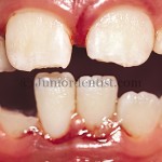 Luxation injuries of Teeth