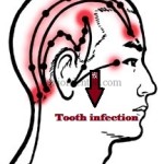 refereed pain in head and region due to tooth infection