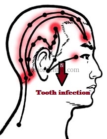 refereed pain in head and region due to tooth infection