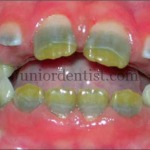 Stains on teeth due to Chromogenic bacteria - Orange, green and yellow stains