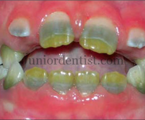 Stains on teeth due to Chromogenic bacteria - Orange, green and yellow stains