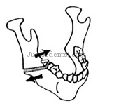 horizontal unfavorable fracture of mandible