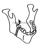 vertical unfavorable fracture of mandible