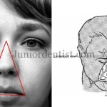 dangerous area of face or dangerous triangle of face