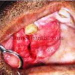 Common site of Metastasis of Carcinoma in Oral cavity