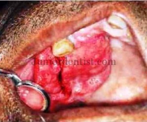 Common site of Metastasis of Carcinoma in Oral cavity