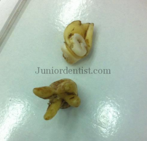 Rare Impaction of 3rd Molar in between Roots of adjacent teeth