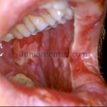 Drugs causing Mucositis or Oral burns