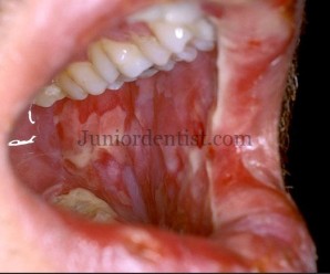 Drugs causing Mucositis or Oral burns