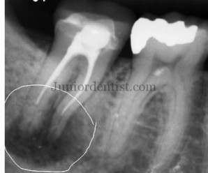 Micro organisms found in failed Root Canal Treated tooth