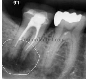 Micro organisms found in failed Root Canal Treated tooth