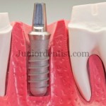 Tissues surrounding Dental Implant