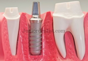 Tissues surrounding Dental Implant