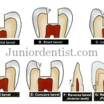 Types of Bevels and their uses in tooth or cavity preperation