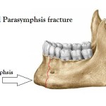 Bilateral Parasymphysis fracture