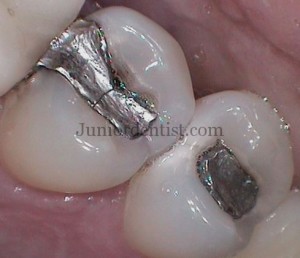 Causes of Failure of Dental Restorations