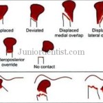 Classification of Condylar Fractures