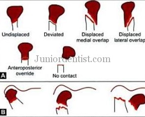 Classification of Condylar Fractures