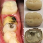 Dental crown loss or Dislodgement