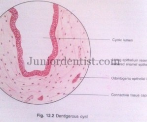 Histologic Features of Dentigerous Cyst